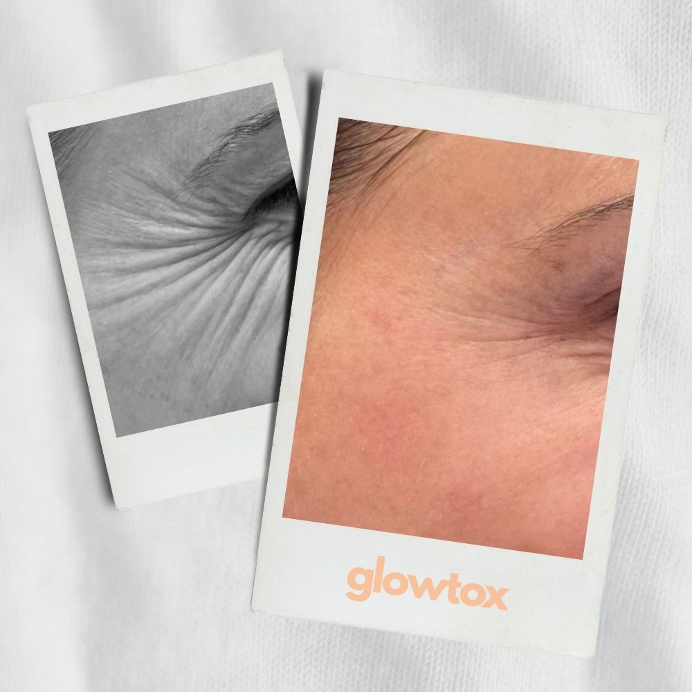 Ergebnis Foto Krähenfüße mit Muskelrelaxansbehandlung blonde Frau glowtox